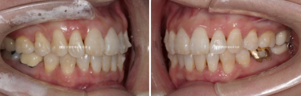 50대 중년교정 인비절라인 라이트 나비치아 교정 앞니 교정 후기 관련 이미지 7
