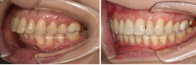 Invisalign Lite for Orthodontic Treatment in Your 40s: Crossbite and Protrusive Mouth Correction image 14