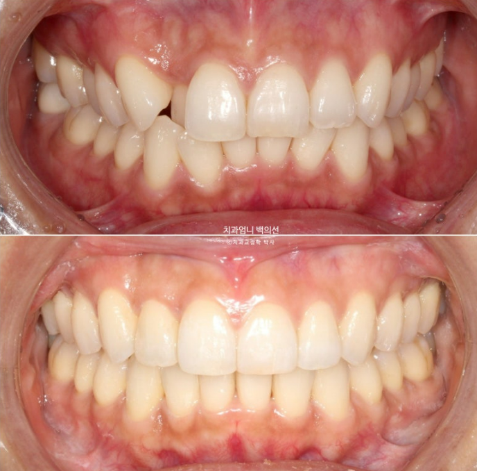 인비절라인 비발치 덧니 교정 반대교합 치료 후기 관련 이미지 1