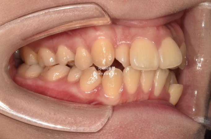 30대 인비절라인 덧니 발치교정 개방교합 치료 관련 이미지 3