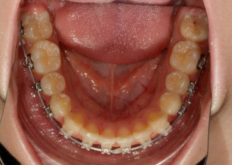 입이 안 다물어짐 입술부전증 호두턱 교정? 관련 이미지 9