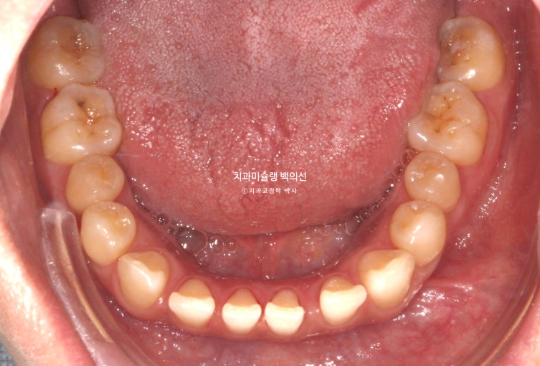 앞니 벌어짐 합죽이 방지 교정 기간 1년 4개월 관련 이미지 2