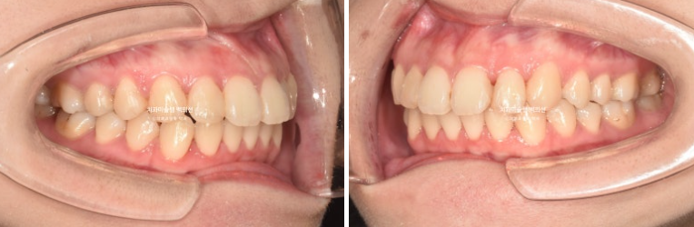 돌출입 인비절라인 발치교정 거미스마일 잇몸미소 잇몸돌출 입술부전증 무턱 재교정 관련 이미지 3