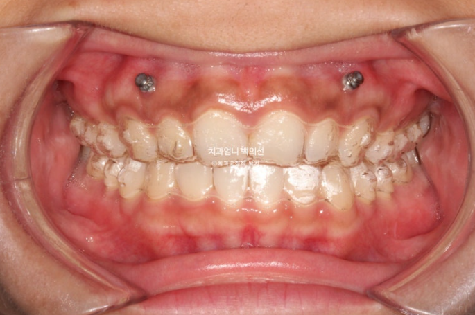 과개교합 옥니 거미스마일 교정 인비절라인 라이트 잇몸성형 후기 관련 이미지 6