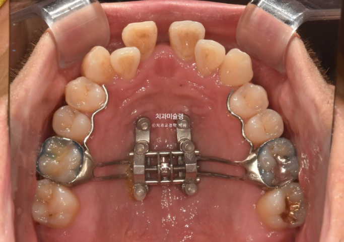 30대 MSE 악궁확장 덧니 반대교합 비발치 클리피씨 부작용 관련 이미지 8