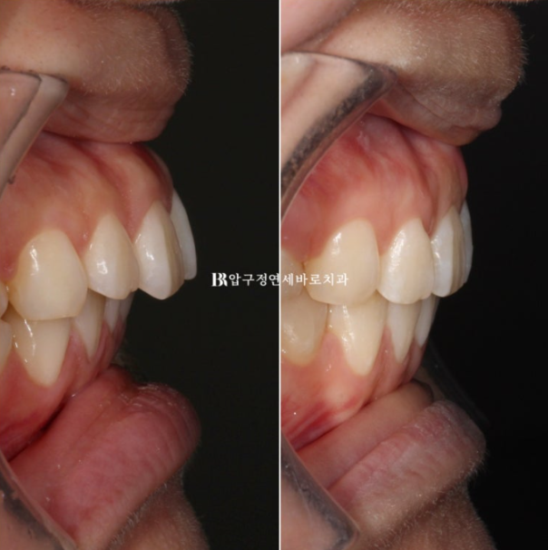 Gummy Smile Correction Review | Natural Improvement of Gummy Smile and Buccal Corridors Through Extraction Treatment for Protruding Teeth image 14