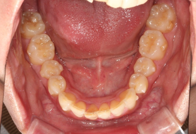 인비절라인 라이트 돌출 과개교합 중심선 교정 치간삭제 치료기간 관련 이미지 8