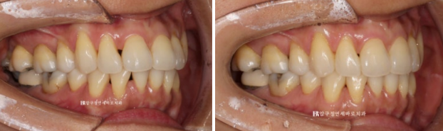 블랙트라이앵글 없애는 교정 가능할까요? 재교정 단기교정 후기 관련 이미지 7