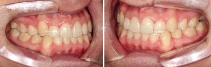 투명교정 인비절라인 덧니 교정 치료기간 알아보기 관련 이미지 9