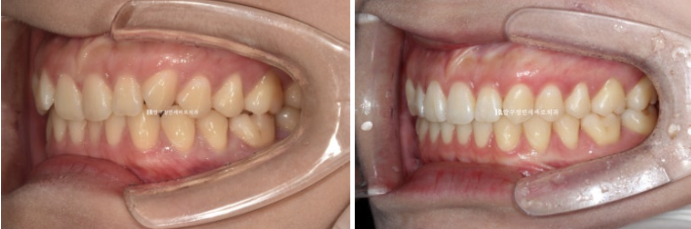압구정 교정치과 / 옥니교정 인비절라인 라이트 덧니교정 관련 이미지 12