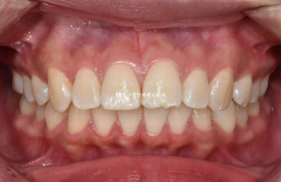 A Review of Extraction Orthodontic Treatment for Protruding Mouth | The Details of Orthodontics That Transform Buccal Corridors and Smile Lines image 2