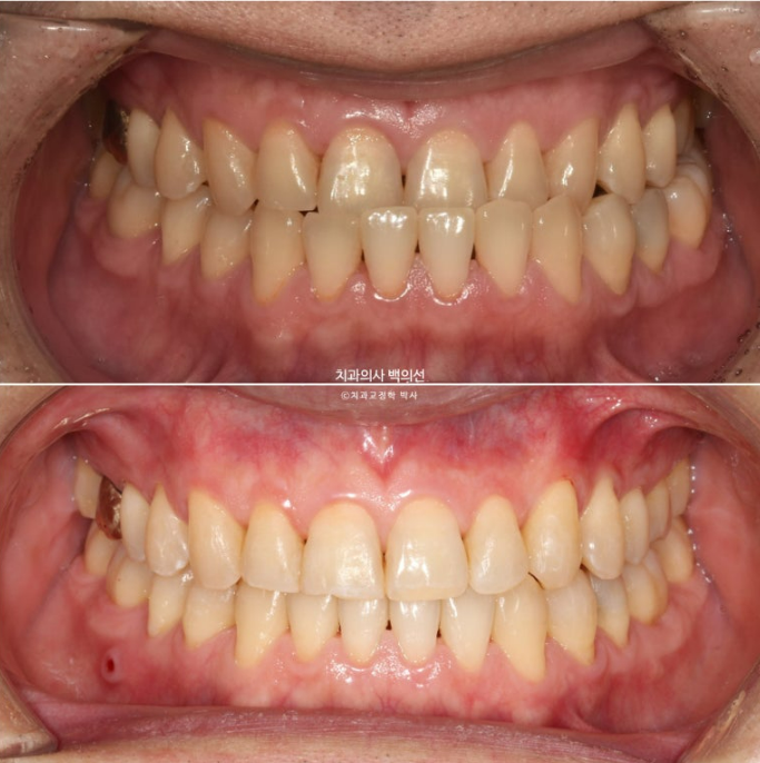 40대 인비절라인 비수술 비발치 주걱턱 비대칭 교정 관련 이미지 1