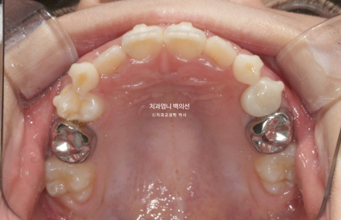 어린이 교정 인비절라인 퍼스트 비대칭 반대교합 어린이 성장 교정 관련 이미지 11