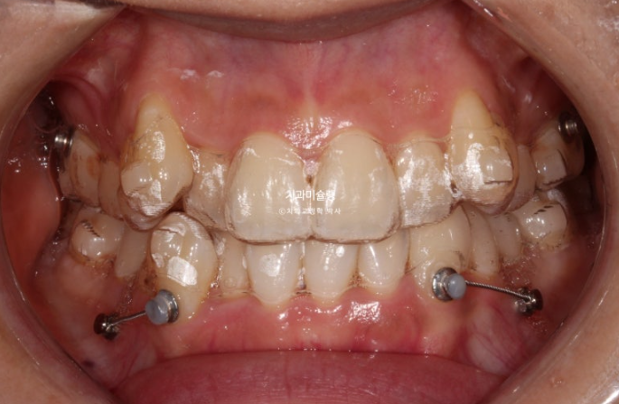 인비절라인 비발치 제2대구치 발치 사랑니 대체 교정 심한 덧니 교정 치료 관련 이미지 9