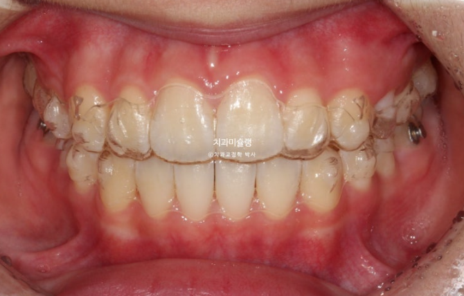 돌출입 비발치 어린이 교정 입술부전증 호두주름 호두턱 토끼이빨 인비절라인퍼스트 관련 이미지 7