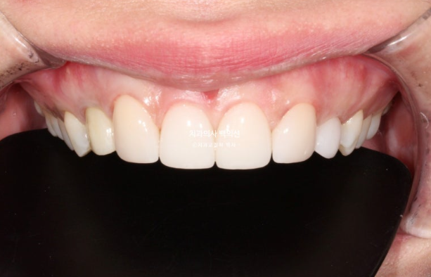 앞니 선천적 결손 벌어짐 잔존 유치 무삭제 라미네이트 관련 이미지 8