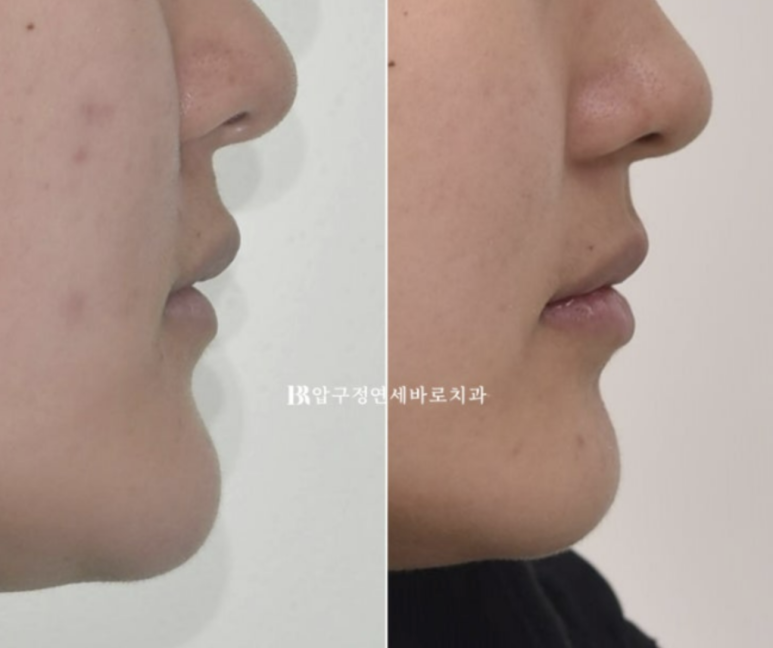 옥니교정 / 웃을때 아랫니만 보여요. 앞니 노출도 교정? 관련 이미지 3