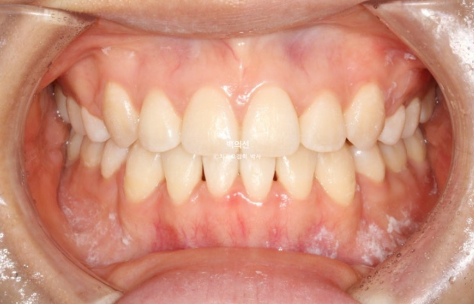 덧니 발치교정 클리피씨 입매 부작용 인중 입술 잇몸 퇴축 관련 이미지 10