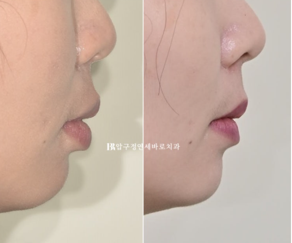 Can't Invisalign Move the Roots? An Actual Case of Extraction Treatment for Protruding Mouth at a Gangnam Orthodontic Clinic image 15