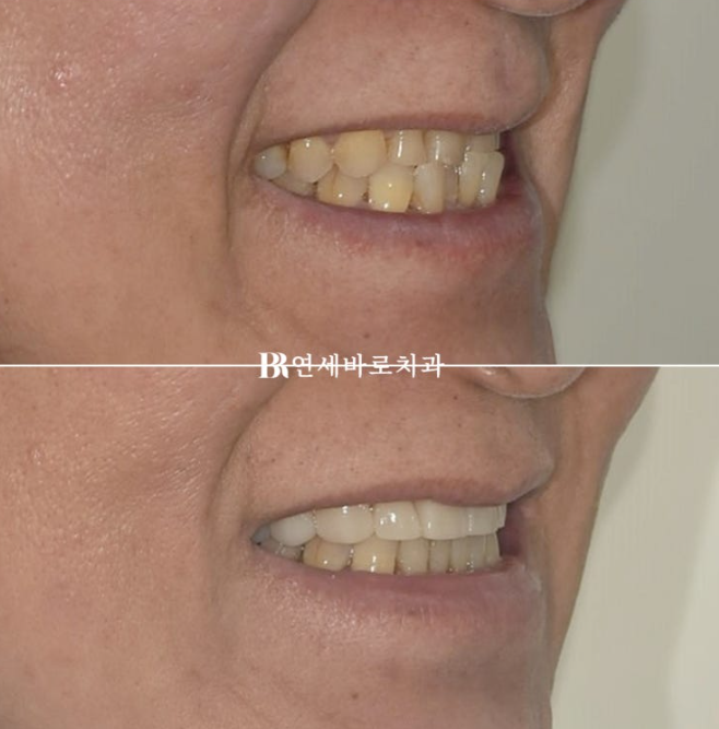무삭제 라미네이트 하러 왔다가 부분교정을 먼저 한 이유 관련 이미지 13