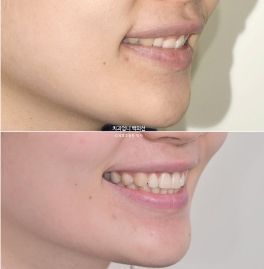 Inward-Tilted Teeth Orthodontic Treatment Review | Actual Case Improved with Non-Extraction Orthodontic Treatment for Gummy Smile, Deep Overbite & Gum Asymmetry — Gangnam Orthodontic Clinic image 1
