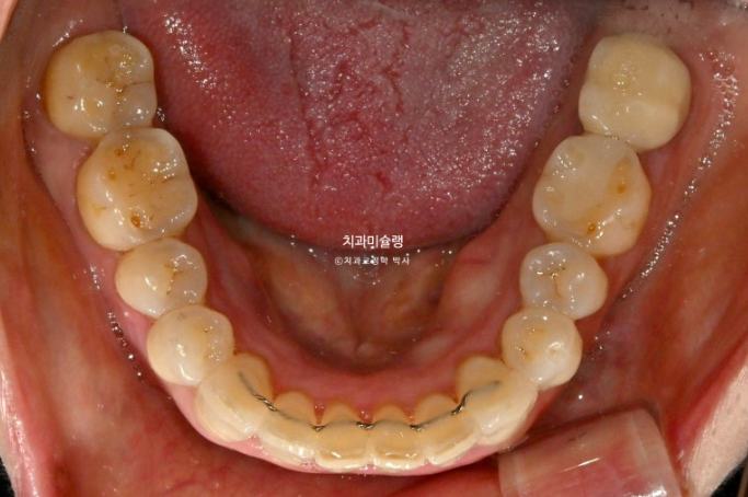 50대 치아교정 돌출 치아벌어짐 중년교정 관련 이미지 15