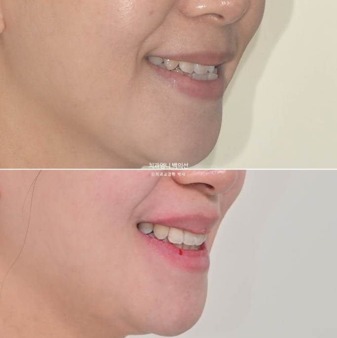 비발치 교정 덧니 인비절라인 교정 절단교합 반대교합 치료기간 1년 6개월 관련 이미지 27