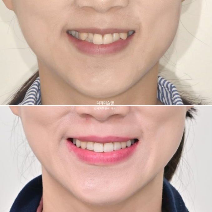 인비절라인 비발치 제2대구치 발치 사랑니 대체 교정 심한 덧니 교정 치료 관련 이미지 24