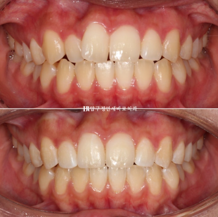 덧니교정 앞니부분교정 치간삭제 후기 관련 이미지 1