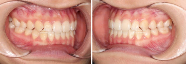 중학생 주걱턱 반대교합 개방교합 덧니 교정 인비절라인 후기 관련 이미지 8