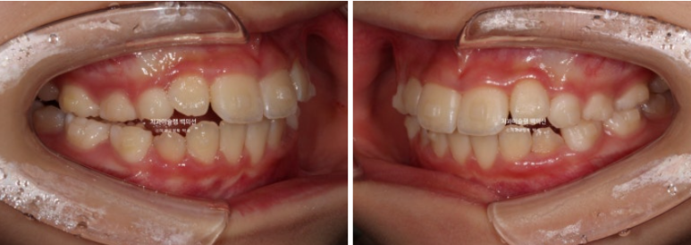 어린이 무턱 성장교정 덧니 인비절라인 퍼스트 악궁확장 치료기간 2년 관련 이미지 11