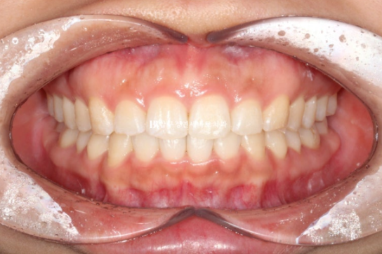 돌출입 교정 치아 벌어짐 인비절라인 투명교정 치료 관련 이미지 7