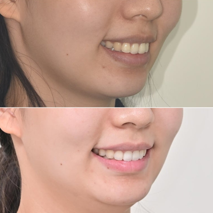 비발치 인비절라인 교정 돌출입 교정 후기 관련 이미지 21