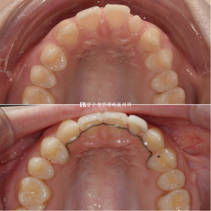 Actual Case of Treating Congenitally Missing and Peg-Shaped Teeth Without Implants image 14