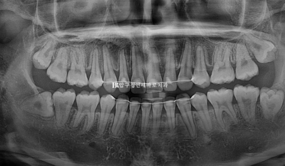 돌출입 교정 입동굴 클리피씨 교정 후기 관련 이미지 18