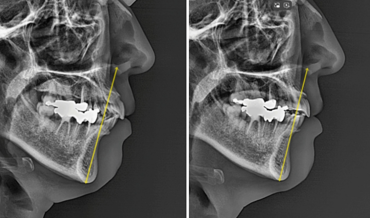 40대 재교정 가능할까요? 비발치 돌출입 교정 호두턱 팔자주름 후기 관련 이미지 7