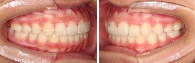 덧니 반대교합 과개교합 인비절라인 퍼스트 악궁확장 어린이 교정 치료 관련 이미지 19