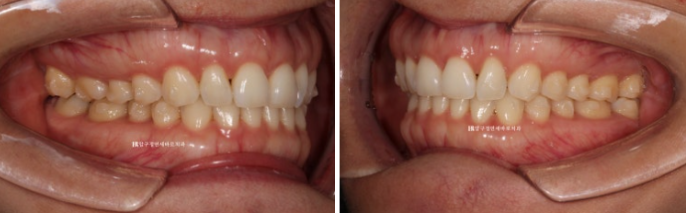 인비절라인 라이트 가위교합 벌어짐 중심선 미니스크류 치료기간 11개월 관련 이미지 5