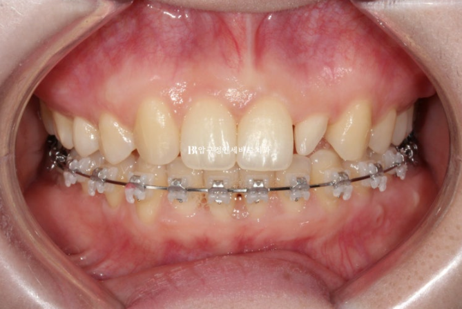 Actual Case of Treating Congenitally Missing and Peg-Shaped Teeth Without Implants image 10