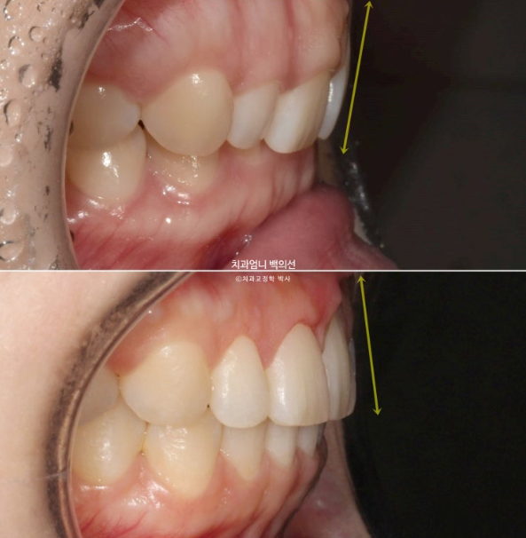 거미스마일 과개교합 교정 잇몸돌출 잇몸 비대칭 관련 이미지 17