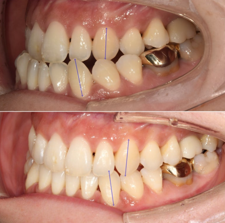 30대 비수술 비발치 주걱턱 부정교합 인비절라인 교정 관련 이미지 14
