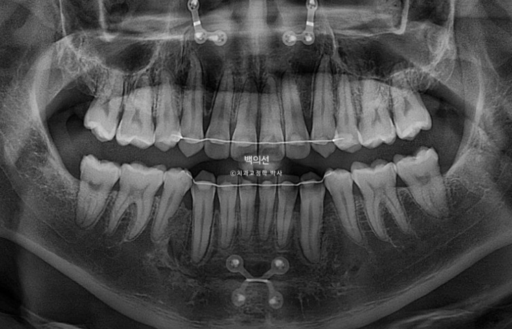 돌출입 수술 ASO + 인비절라인 라이트 후교정 치료기간 10개월 관련 이미지 16