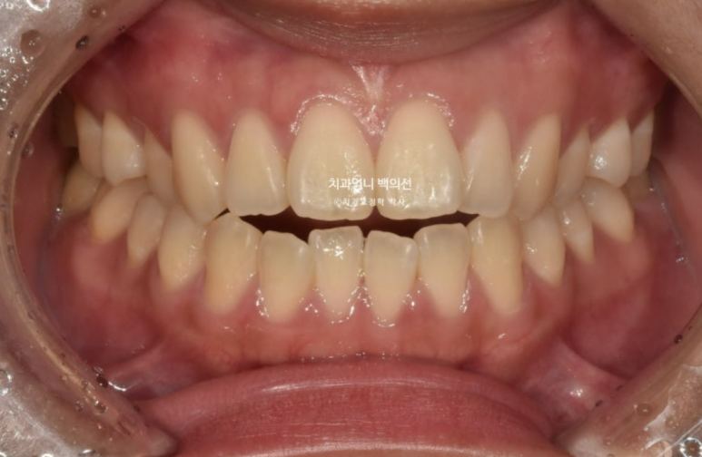 인비절라인 개방교합 교정 어금니 함입 교정 비베라? 관련 이미지 1