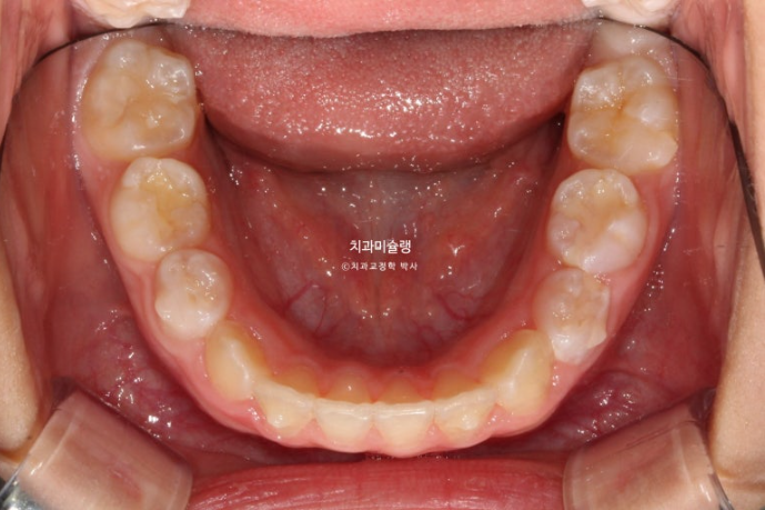 어린이 돌출입 교정 무턱 투명교정 인비절라인 퍼스트 관련 이미지 12