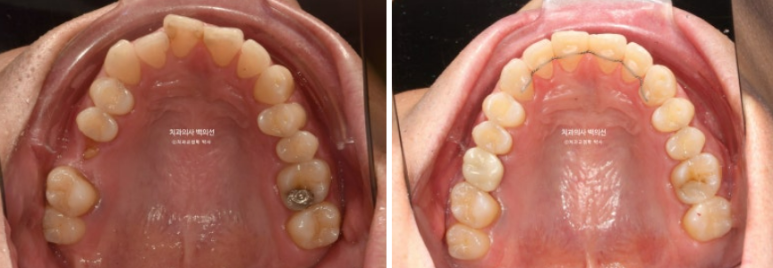 40대 인비절라인 라이트 과개교합 과잉치 덧니 교정 임플란트 보철 교정 후기 관련 이미지 18