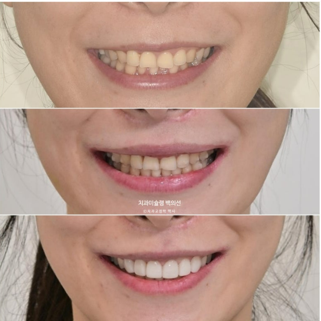 비발치 덧니 교정 인비절라인 과개교합 교정 무삭제 라미네이트 치료 후기 관련 이미지 25