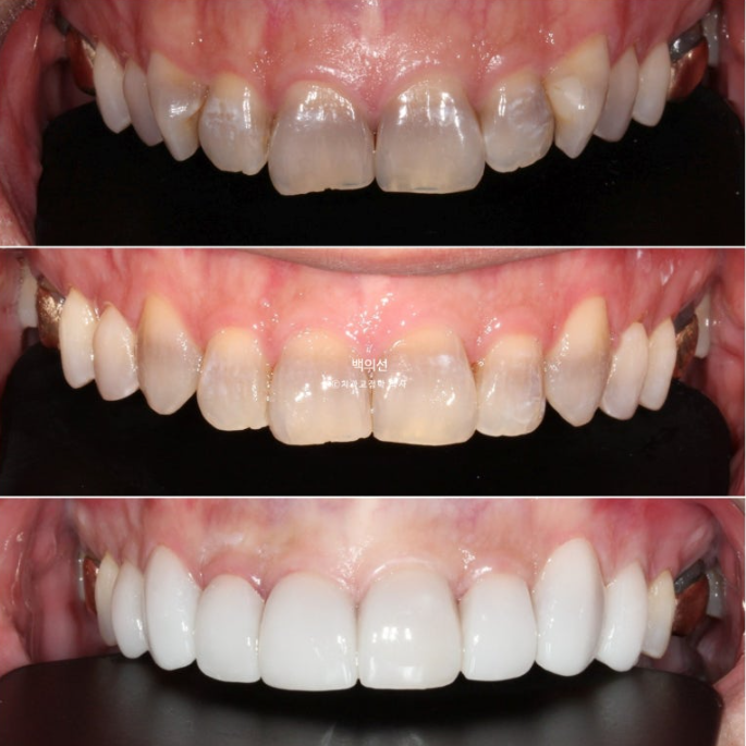 Treatment Review: No-Prep Laminate for Tetracycline-Stained Teeth image 15