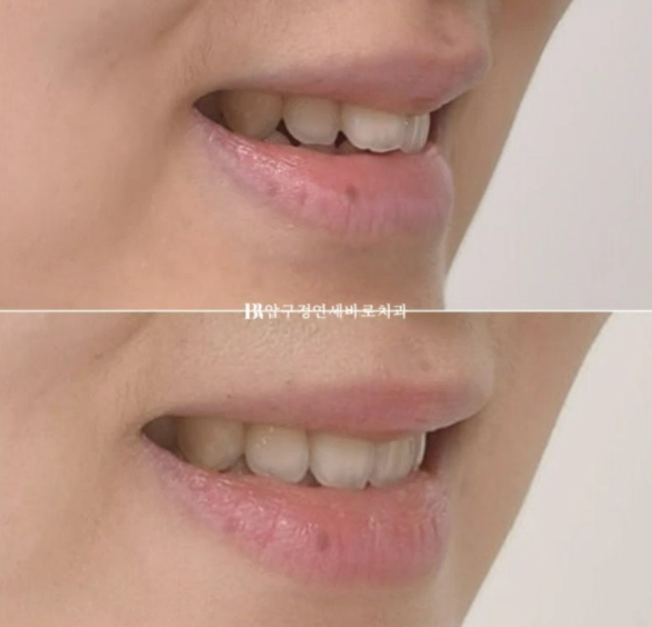 인비절라인 익스프레스 토끼이빨 앞니교정 ? 관련 이미지 15