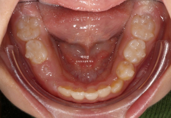 인비절라인퍼스트 어린이 투명교정 과개교합 덧니 악궁확장 돌출 관련 이미지 10