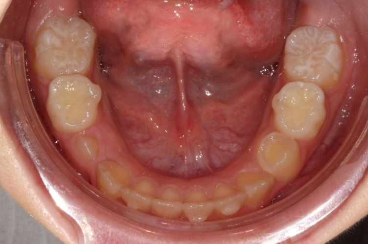 어린이 무턱 성장교정 덧니 인비절라인 퍼스트 악궁확장 치료기간 2년 관련 이미지 21